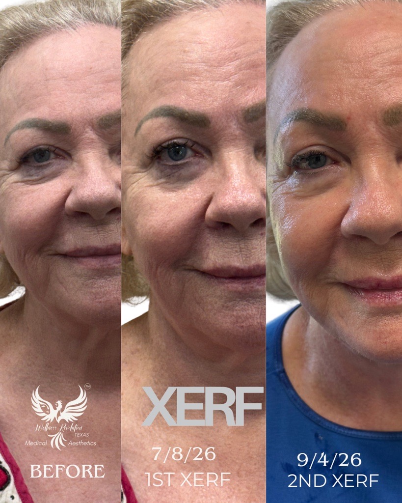 XERF body contouring result 1