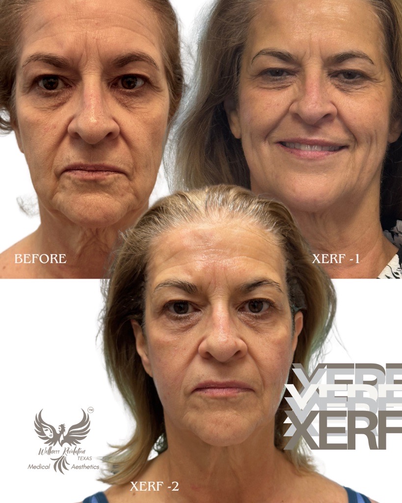 XERF body contouring result 2